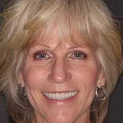 Cosmetic Smile Makeover — after