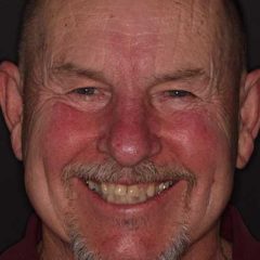 Full Mouth Reconstruction — before