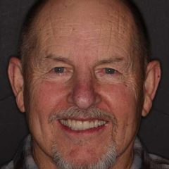 Full Mouth Reconstruction — after
