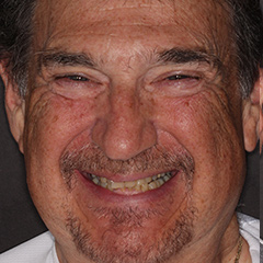 Full Mouth Reconstruction — before