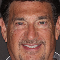 Full Mouth Reconstruction — after