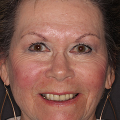 Cosmetic Smile Makeover — before, case 4