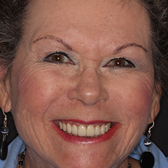 Cosmetic Smile Makeover — after, case 4