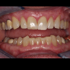 Full Mouth Reconstruction — before, case 5
