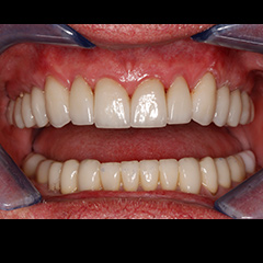 Full Mouth Reconstruction — after, case 5