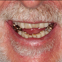 Full Mouth Reconstruction — before, case 6