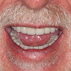 Full Mouth Reconstruction — after, case 6