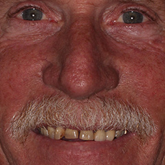 Full Mouth Reconstruction — before, case 7