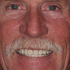 Full Mouth Reconstruction — after, case 7